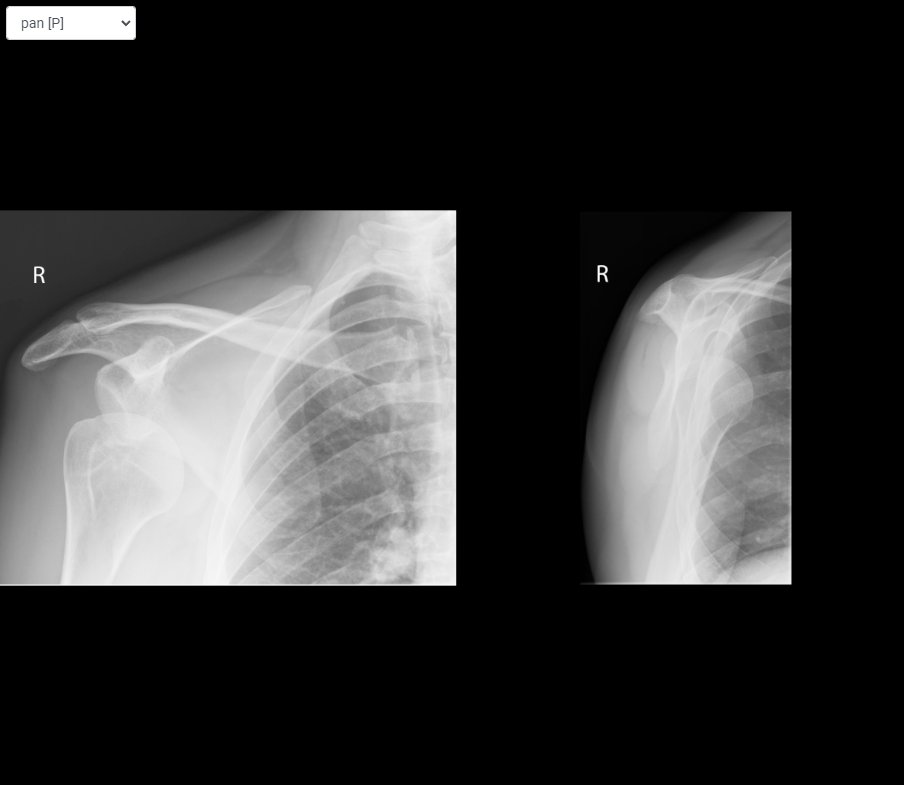 reviseradiology's tweet photo. 📌Today's Rapid Reporting Question
Normal or abnormal? If Abnormal, Name the Abnormality.
#frcr #stradiology #radiologyregistrar #frcr2b #radiology #xray #radiologist #mri #imaging #xrays #ct #ctscan #medicalimaging #ultrasound
#rapidreporting #frcrrapidreporting https://t.co/4Aka56wCJJ