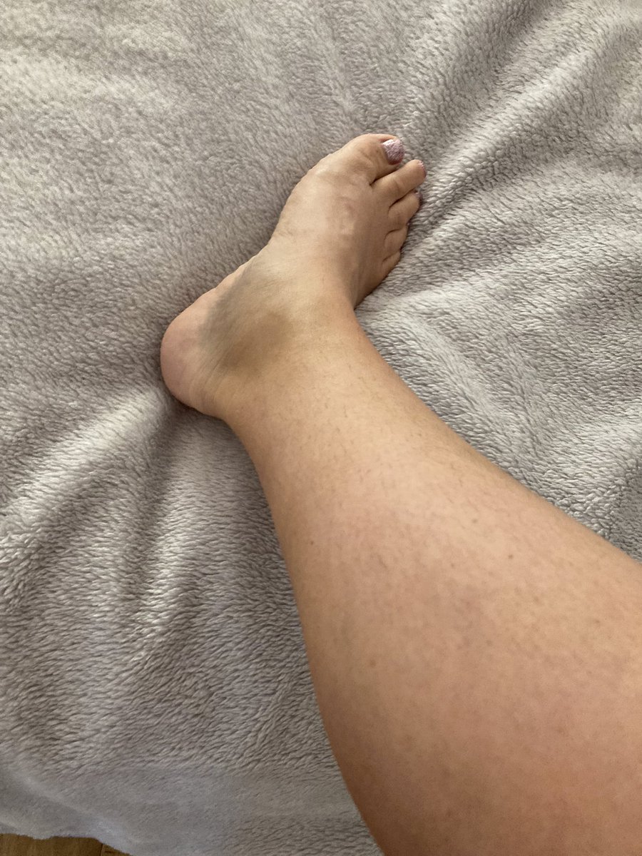 Charl1789's tweet photo. Ankle bruising with a calf strain?……weird 🤷‍♀️ https://t.co/VOclovPXj0