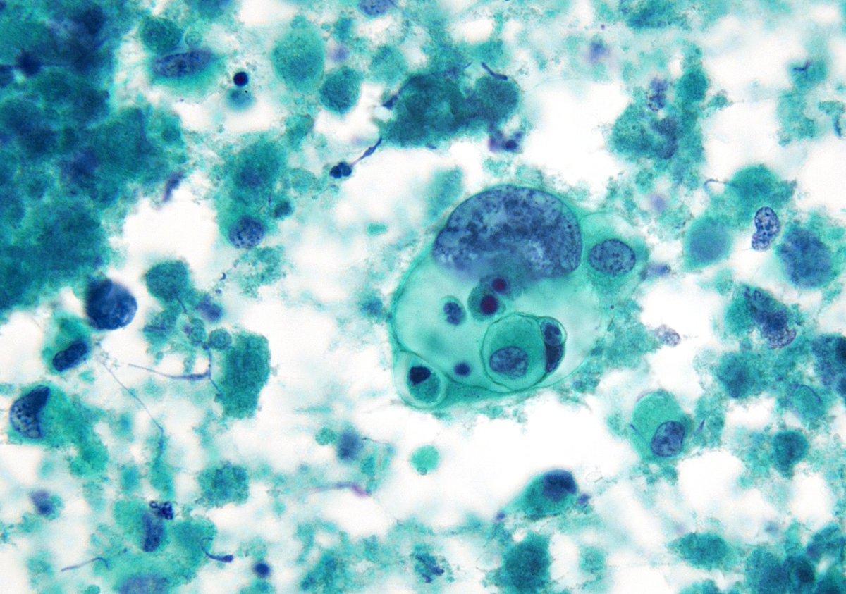 sza_jhcyto's tweet photo. "Living up to its reputation" - Undifferentiated (Anaplastic) Thyroid Carcinoma. Pleomorphic - Necrotic - Cannibalistic. (FNA) https://t.co/PKZMbYh6w8