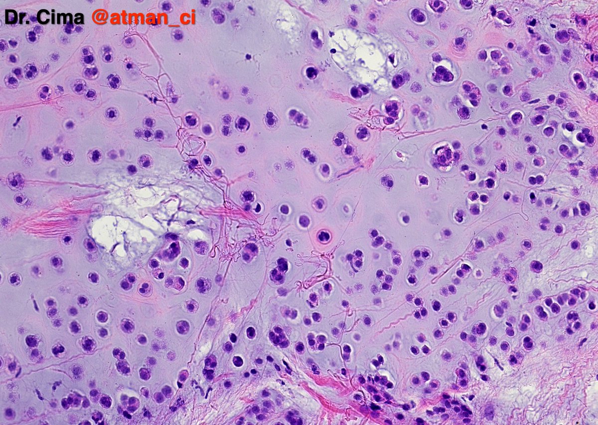 Dr. Luca (@atman_ci) on Twitter photo A return to #BreastPath with two biopsies for the #PathTwitter Friends! N°1: 52yF, 11mm nodule, R4, how would you interpret it? IHCs? <a href="/PoloniaAntonio/">A. Polónia</a> <a href="/LoboAnandi/">Anandi Lobo, MD</a> <a href="/sumeyra_md/">Sumeyra Kartal</a> <a href="/HansiniMD/">Hansini Laharwani</a> <a href="/shahidi_hossein/">M.hossein shahidi</a> <a href="/SumantaDas_7/">Sumanta Das</a> <a href="/NeoCrazee/">SANO Naoki, MD, Pathologist, Japan</a> <a href="/nandinipath/">Nandini govindarajan</a> <a href="/GeronimoJrLapac/">Gerônimo Jr.</a> <a href="/mhassanaimc/">Masood Hassan</a> <a href="/QassidO/">Dr Omar Layth Qassid, FRCPath(UK) iFCAP(USA)</a> A return to #BreastPath with two biopsies for the #PathTwitter Friends! N°1: 52yF, 11mm nodule, R4, how would you interpret it? IHCs? <a href="/PoloniaAntonio/">A. Polónia</a> <a href="/LoboAnandi/">Anandi Lobo, MD</a> <a href="/sumeyra_md/">Sumeyra Kartal</a> <a href="/HansiniMD/">Hansini Laharwani</a> <a href="/shahidi_hossein/">M.hossein shahidi</a> <a href="/SumantaDas_7/">Sumanta Das</a> <a href="/NeoCrazee/">SANO Naoki, MD, Pathologist, Japan</a> <a href="/nandinipath/">Nandini govindarajan</a> <a href="/GeronimoJrLapac/">Gerônimo Jr.</a> <a href="/mhassanaimc/">Masood Hassan</a> <a href="/QassidO/">Dr Omar Layth Qassid, FRCPath(UK) iFCAP(USA)</a>