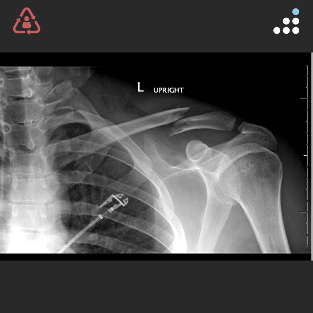 Orthobullets on Twitter "Here’s a new case by Dr. Steven Wahlmeier and