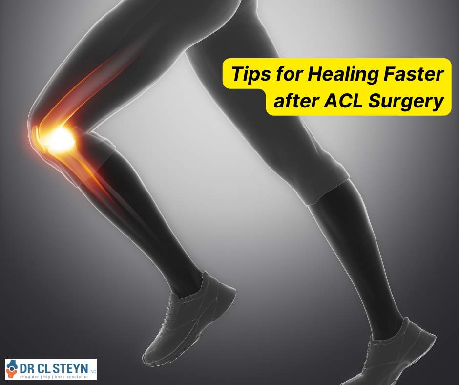 DrCLSteyn's tweet photo. Tips for Healing Faster after ACL Surgery Dr. CL Steyn Inc - Shoulder Surgeon - Cape Town https://t.co/ftJyVRCVzi #drclsteyn #kneesurgery #orthopaedicsurgeon #shoulderdoc #shouldersurgery https://t.co/JsvKZAUDQT