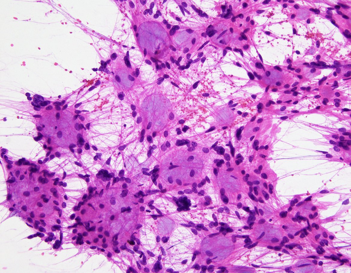 JaredAhrendsen's tweet photo. #FrozenSectionFriday with smear prep of a spinal cord mass. Diagnosis? What is the likely location in the spinal cord? #neuropath #PathTwitter #purplepath https://t.co/XK6Gsw133r