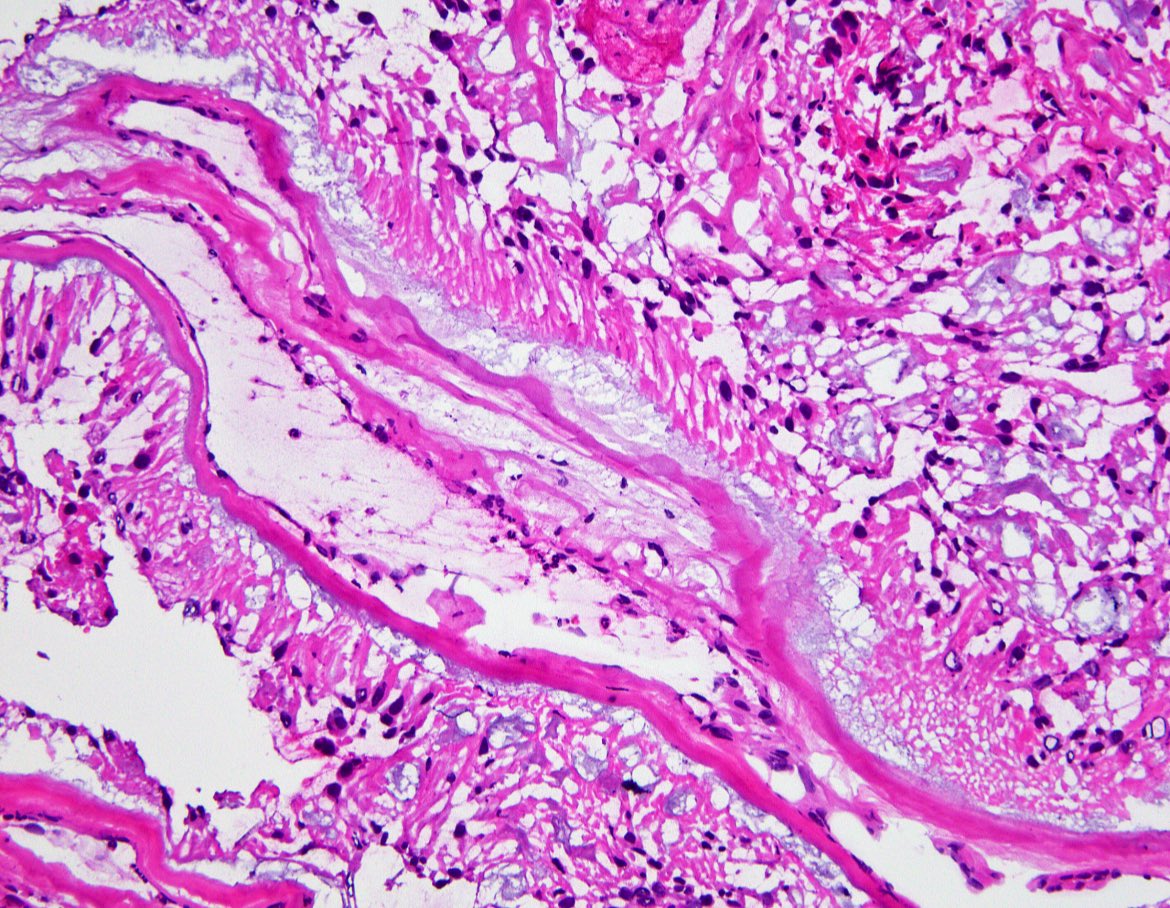JaredAhrendsen's tweet photo. #FrozenSectionFriday with smear prep of a spinal cord mass. Diagnosis? What is the likely location in the spinal cord? #neuropath #PathTwitter #purplepath https://t.co/XK6Gsw133r