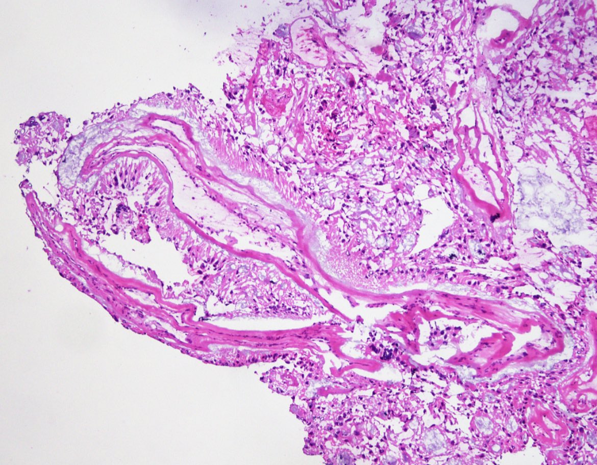 JaredAhrendsen's tweet photo. #FrozenSectionFriday with smear prep of a spinal cord mass. Diagnosis? What is the likely location in the spinal cord? #neuropath #PathTwitter #purplepath https://t.co/XK6Gsw133r