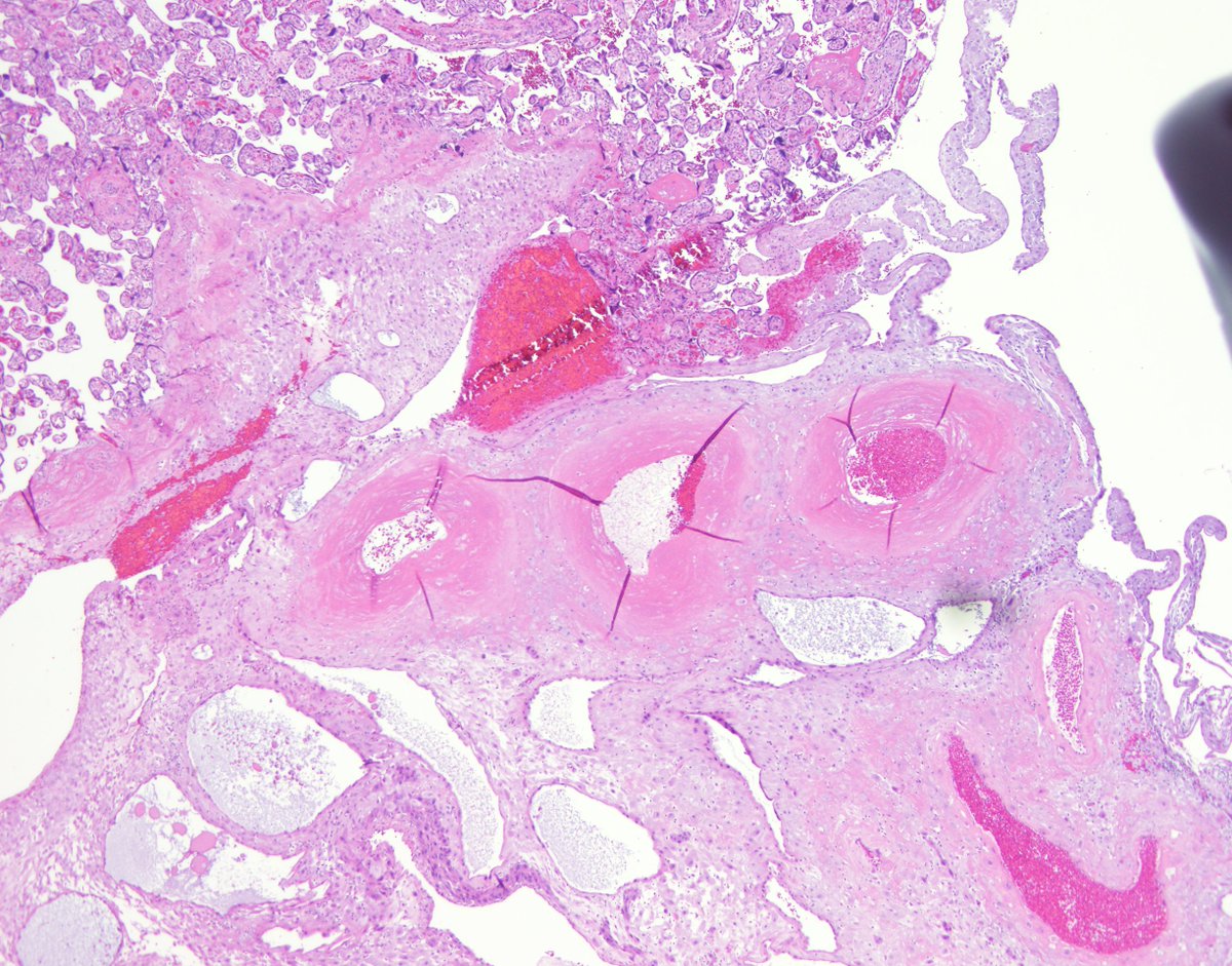 Pathology residents, what is this placental finding and clinical associations? #placenta #pathology #GYNpath #MedEd