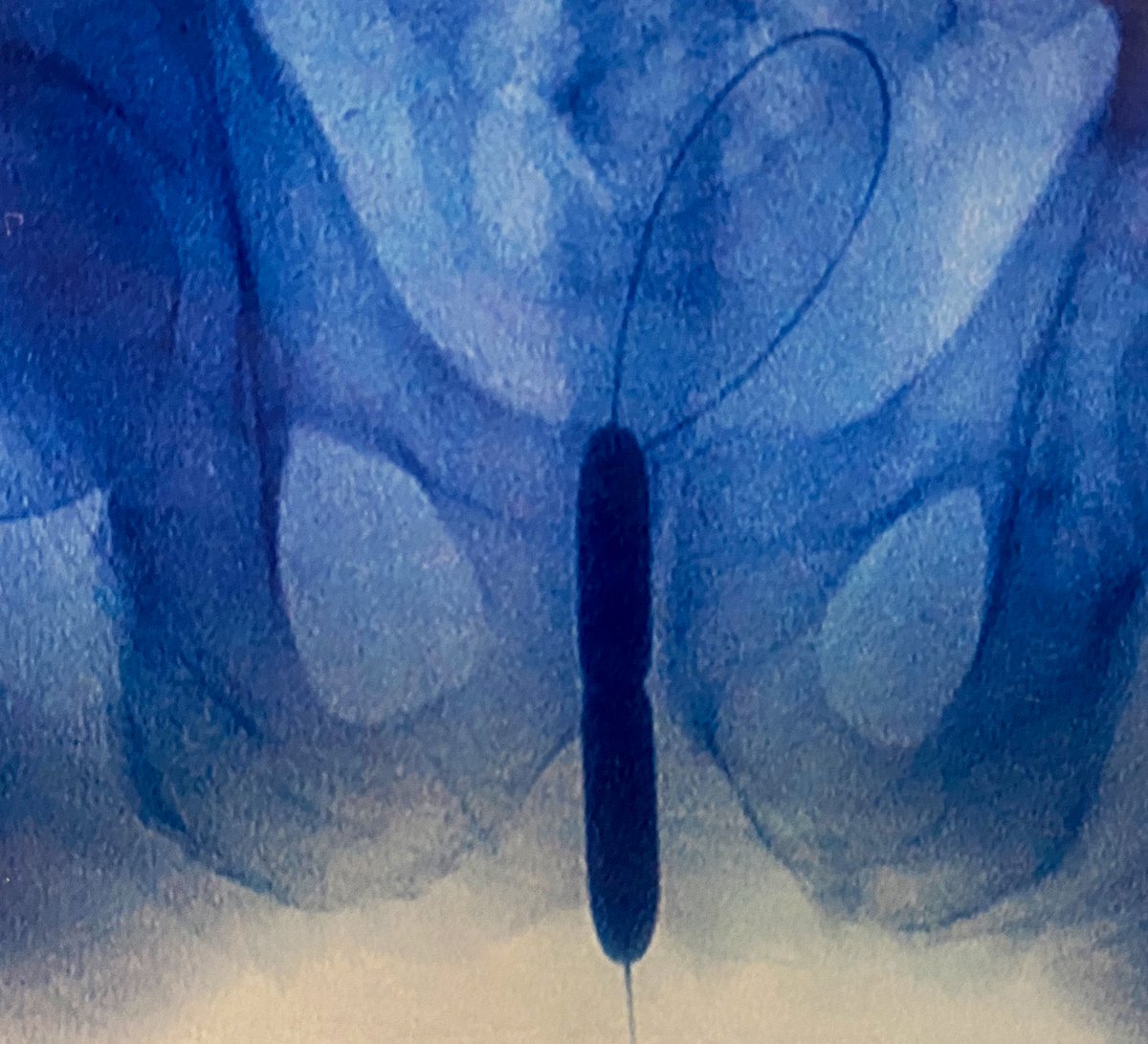 Ricardo R Gonzalez MD (@rrgonzalezmd) on Twitter photo Have y’all tried Optilume for membranous ureteral strictures post-radiation for prostate cancer?
Anecdotally, patients doing well to date (<1 year). Thoughts? <a href="/mccammonka/">Kurt McCammon</a> <a href="/ecosterberg/">E. Charles Osterberg, MD, FACS</a> <a href="/WessellsHunter/">Hunter Wessells</a> <a href="/nathanstarkemd/">Nathan Starke, MD</a> <a href="/SPuro88/">Sravan Panuganti, DO, FACOS</a> <a href="/DrUroRecon/">Rajveer Purohit MD, MPH</a> Have y’all tried Optilume for membranous ureteral strictures post-radiation for prostate cancer?
Anecdotally, patients doing well to date (<1 year). Thoughts? <a href="/mccammonka/">Kurt McCammon</a> <a href="/ecosterberg/">E. Charles Osterberg, MD, FACS</a> <a href="/WessellsHunter/">Hunter Wessells</a> <a href="/nathanstarkemd/">Nathan Starke, MD</a> <a href="/SPuro88/">Sravan Panuganti, DO, FACOS</a> <a href="/DrUroRecon/">Rajveer Purohit MD, MPH</a>