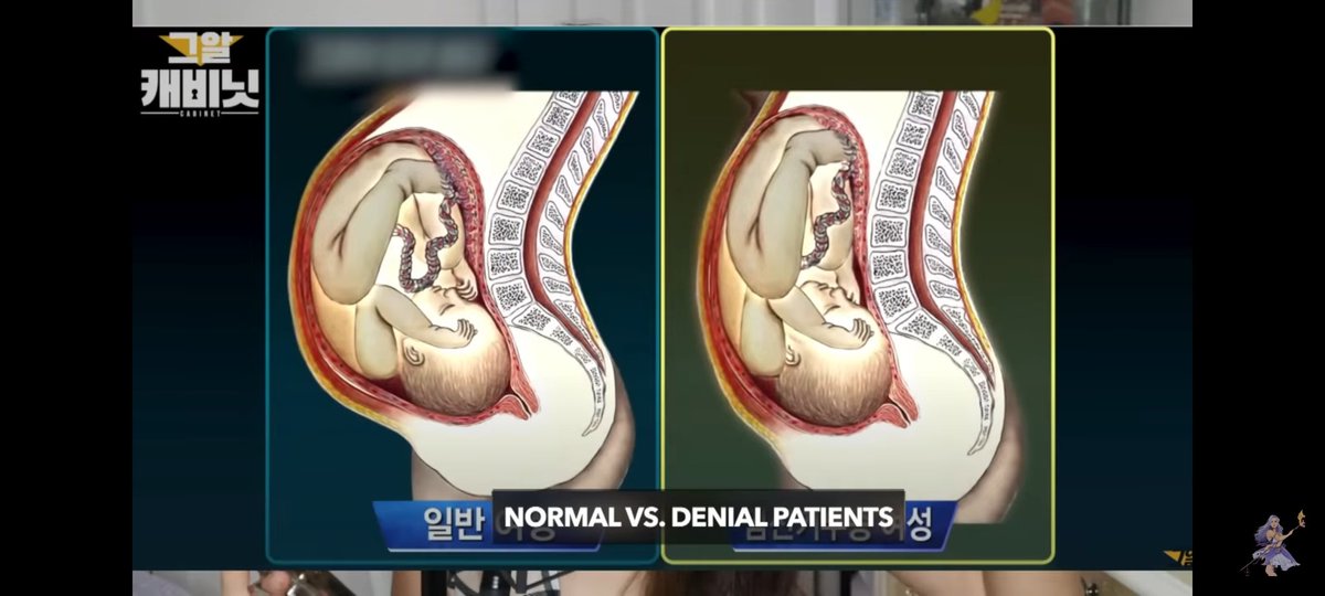 apriseuldiyana's tweet photo. Bagaimana mungkin perutnya tidak terlihat mengalami kehamilan? Lihatlah foto di bawah.

Ini adalah perbedaan pasien normal dan pasien 'denial of pregnancy'

Ya, ternyata pikiran pasien mempengaruhi bentuk tubuh dan kondisi kehamilannya. https://t.co/fX0xDzCWMp