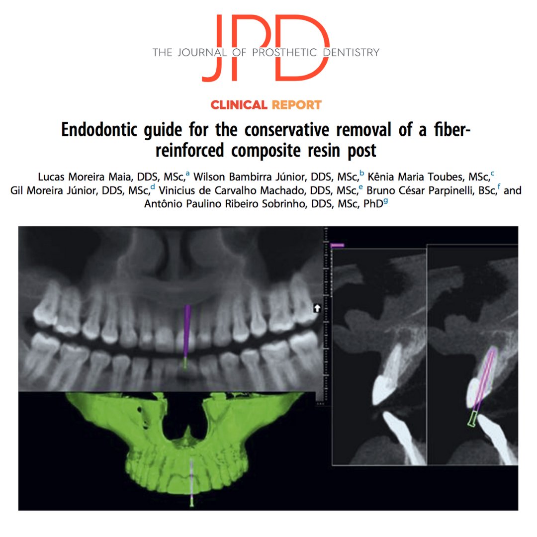 JPDentistry's tweet photo. #digitaldentistry techniques combining #CBCT and #3dprinted #surgicalguides are used to create an efficient and effective guide for removing #endodonticposts predictably as described in this article from the latest issue of #theJPD. Learn more: https://t.co/CjDJV8Jpff https://t.co/oSf1uf0TFf