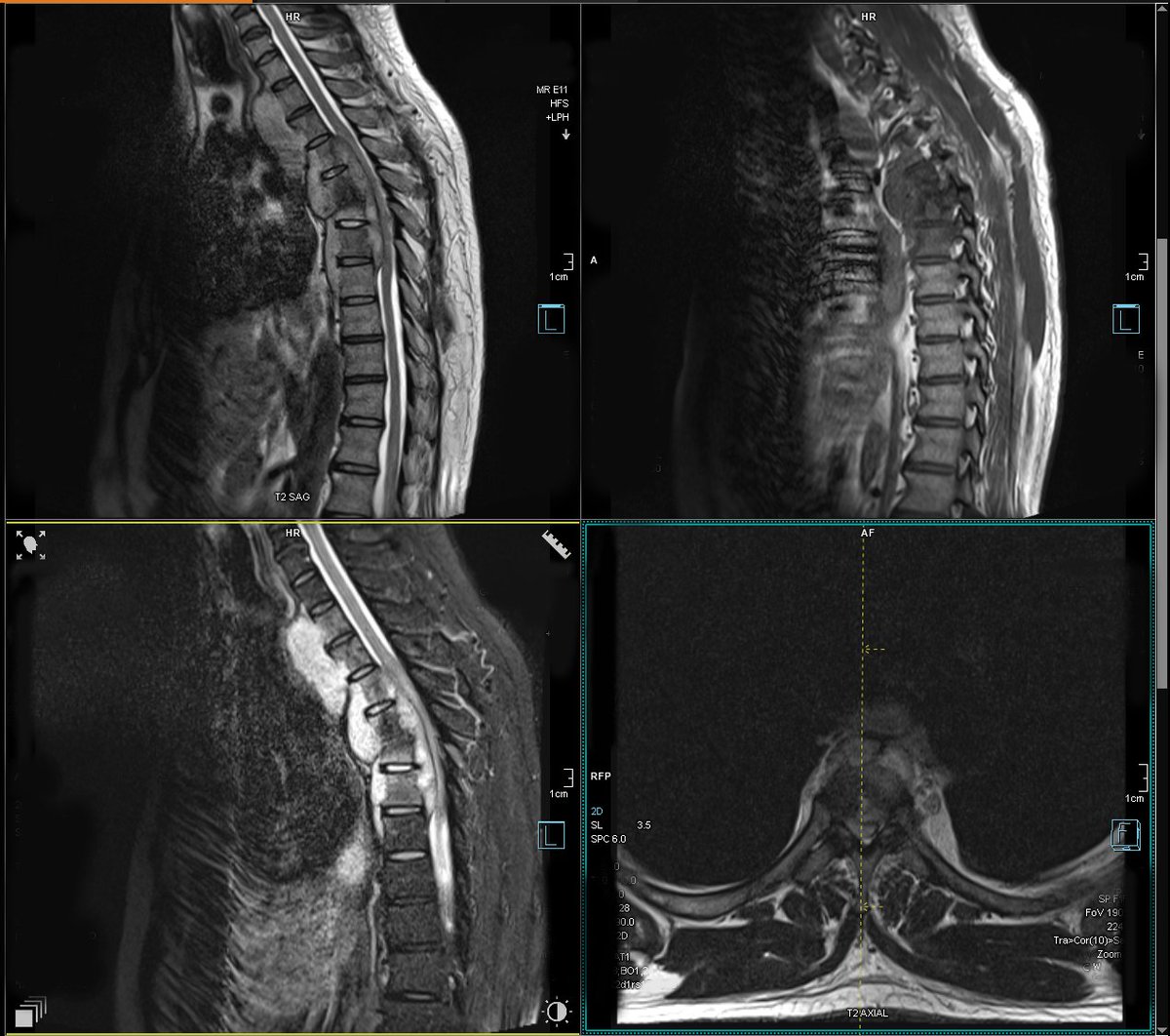 spectrahealthgh's tweet photo. TGIF
Thoracic MRI

T2 to T7 showing #osteitis with #discitis at #T5 to T6 level with a Large abscess formation with diffuse cord compression and cord #edema 
TGIF
#mri #mripro #radiopedia #radiology https://t.co/QDNUrzbX4k