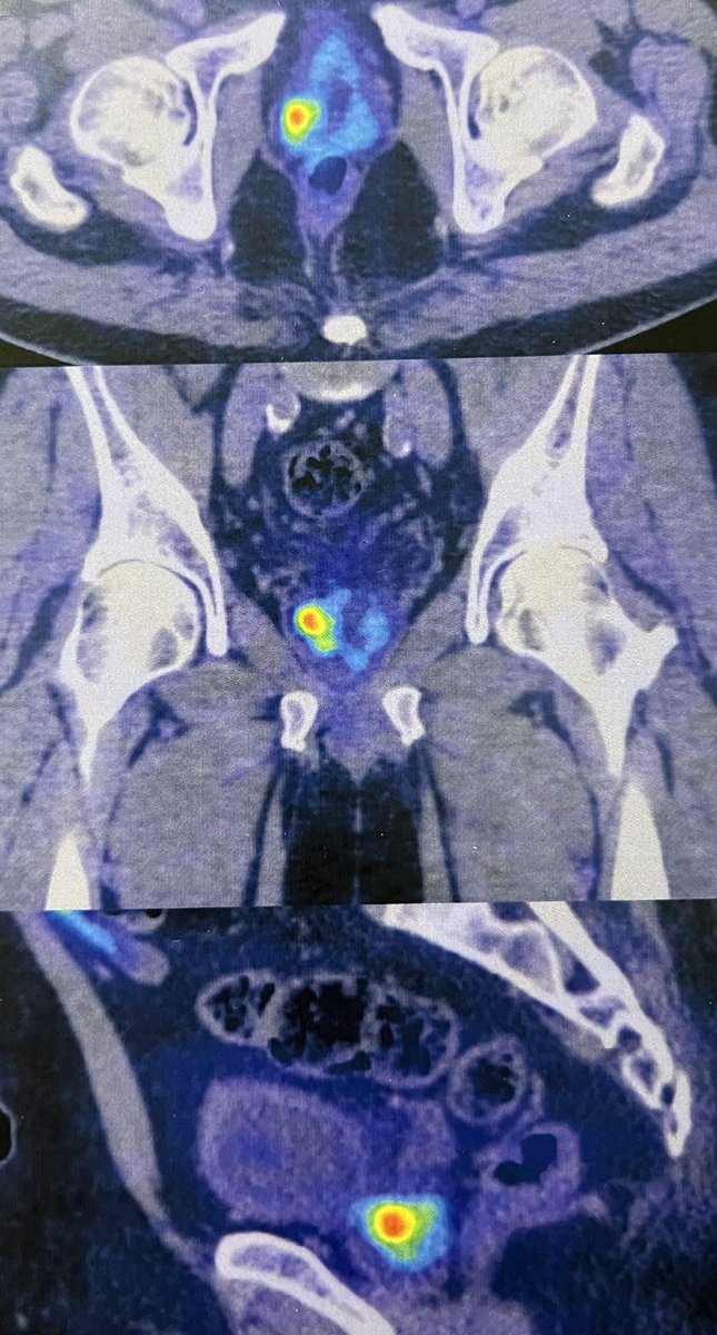 RomanCarvajal's tweet photo. MRI lesión PIRADS 4 en lóbulo derecho, #PETCTPSMA involucramiento total, el futuro integrará ambas imágenes #fusion, con mayor identificación pre-biopsias y una etapificación más precisa. @dandanmena las tablas predictivas integrarán ambas imágenes además de un panel genético. 😎 https://t.co/tdePf0l57R