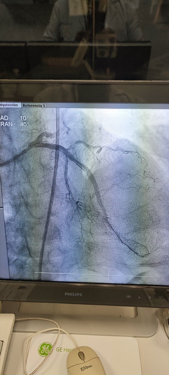 Abcsm74's tweet image. 🫀⚡👴🏼84 a.Trivascular #CTO #DA calcio #Stingray #ShockWave 1ro en @HemoMacGregor DA #Fullmetal #PromusElement #MasterComplex #ProgramaCTOMacGregor 👍🏼
@MedstentSAdeCV  @BostonSciLatam