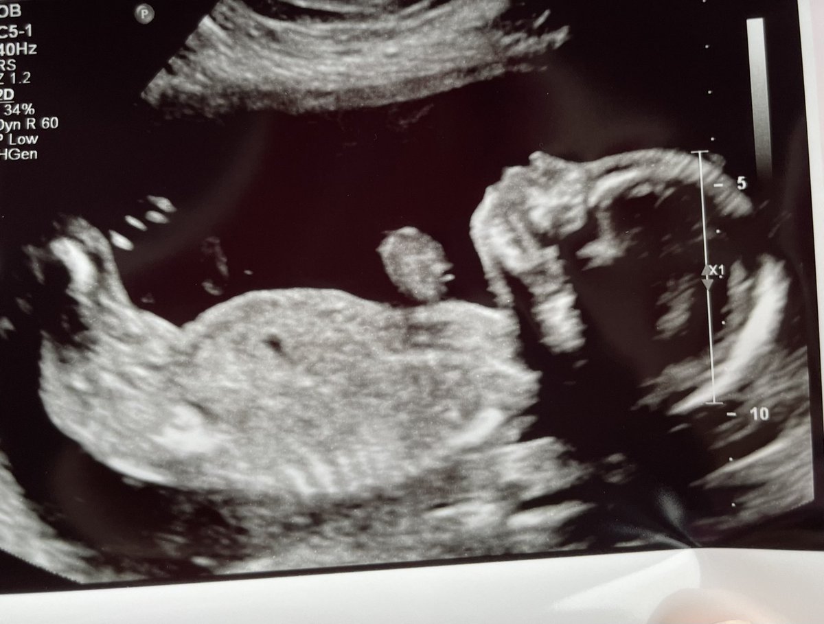 kmazur09's tweet photo. 20 weeks down 20 to go with baby M! Healthy and the tech said the most active she has scanned in a while 😅☺️ @footballcrdonly https://t.co/6ClDxW4PJO