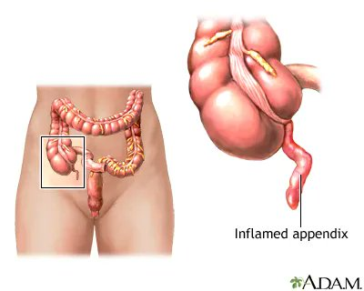 DrImranSheikh's tweet image. Did you know? 🤔 Symptoms of appendix cancer are similar to acute #appendicitis. Many people with appendix cancer are diagnosed after the appendix is removed. #AppendixCancerAwarenessMonth 
📸: @medlineplus
cancer.gov/pediatric-adul….