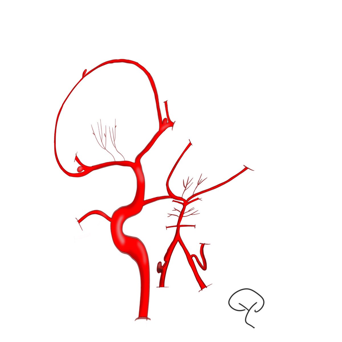 thomas_yasuda's tweet photo. A bunch of intracranial aneurysms but 4 different pathophysiologies! https://t.co/3tlgnPLpRI