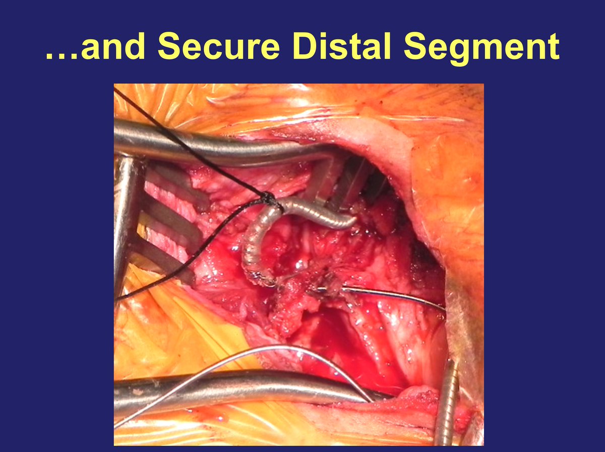 <a href="/dredcronin/">Edmond Cronin</a> <a href="/EJSMD/">Edward J Schloss MD</a> <a href="/rdschaller/">Robert Schaller</a> <a href="/krishpothineni/">Krishna Pothineni</a> <a href="/SivaMulpuruMD/">Siva Mulpuru MD MPH</a> <a href="/aalahmadmd/">Amin Al-Ahmad, MD</a> <a href="/DrGeorgeShaw/">George Shaw</a> <a href="/tscherian/">Tharian Cherian MD</a> <a href="/djdardenMD/">Doug Darden</a> <a href="/rajeshkabramd/">Rajesh Kabra</a> <a href="/DJ_Lakkireddy/">DJ Lakkireddy</a> <a href="/drrakeshg1/">Rakesh Gopinath</a> <a href="/khaldountarakji/">Khaldoun Tarakji</a> See this tweet and next for some images from a couple cases where leads fragmented at costoclavicular ligament, and needed to pull it out of the vessel to gain control and access to distal lumen for locking stylet placement. 1/2
#ExtractionFinesse 😂