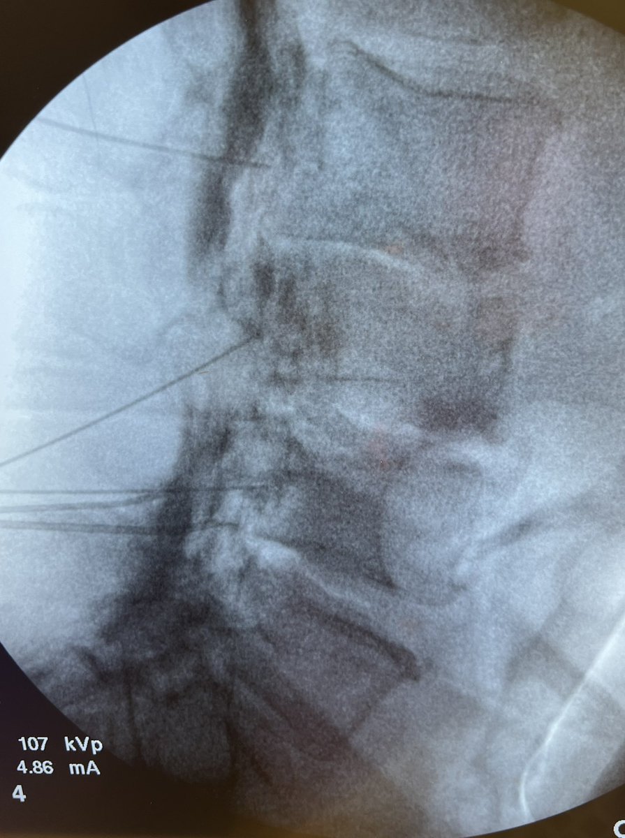 dougbeall's tweet photo. Difficult Racz procedure but eventually established epidural flow to the right exiting nerve roots at 2–3, 3–4, and 4–5. Patient doing great and I’m very happy with the immediate results https://t.co/yWmDD8Errs