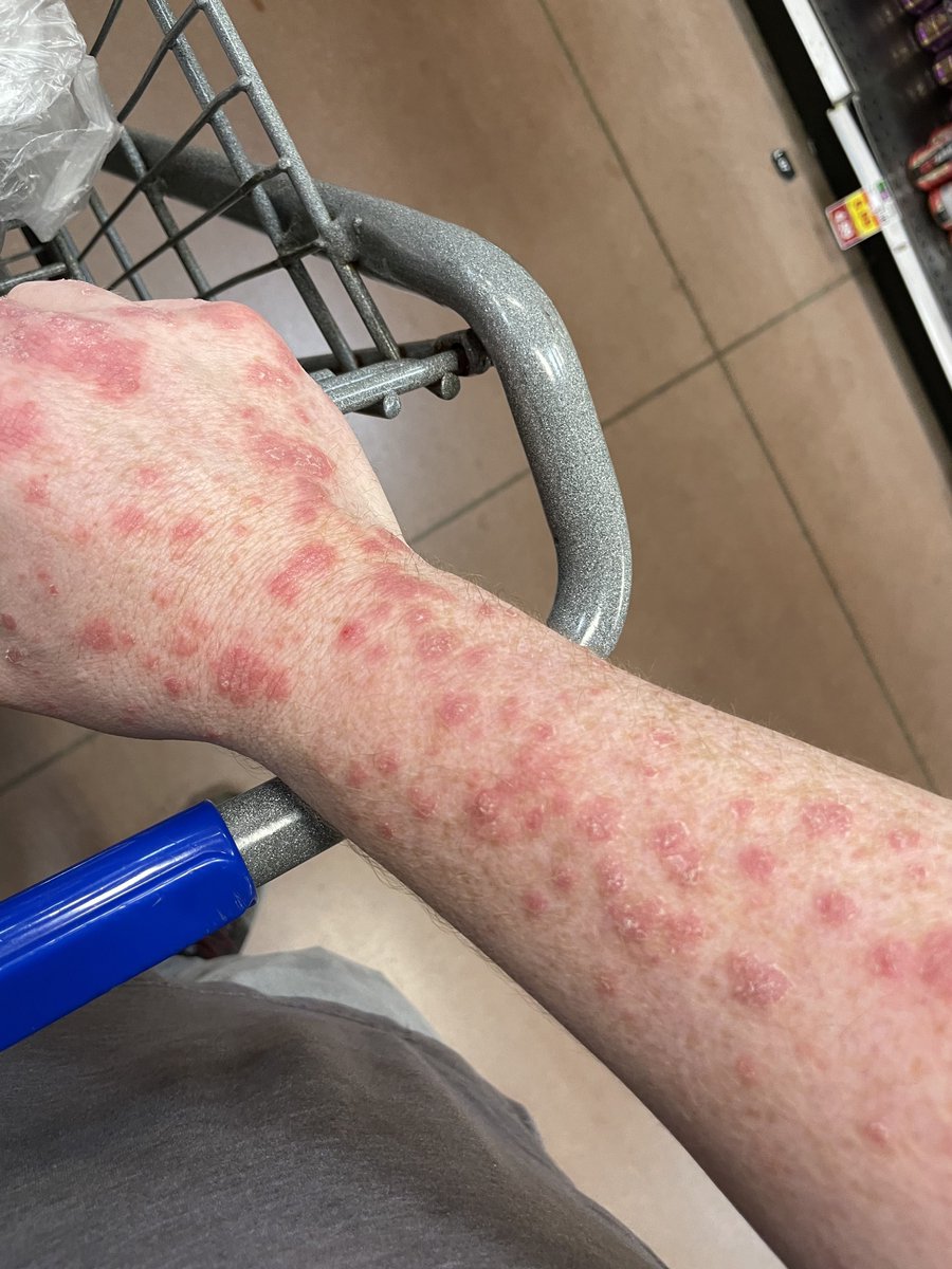 Be kind to your friends with psoriasis. We don’t have monkeypox, we are still people who hurt when you recoil at the sight of us.