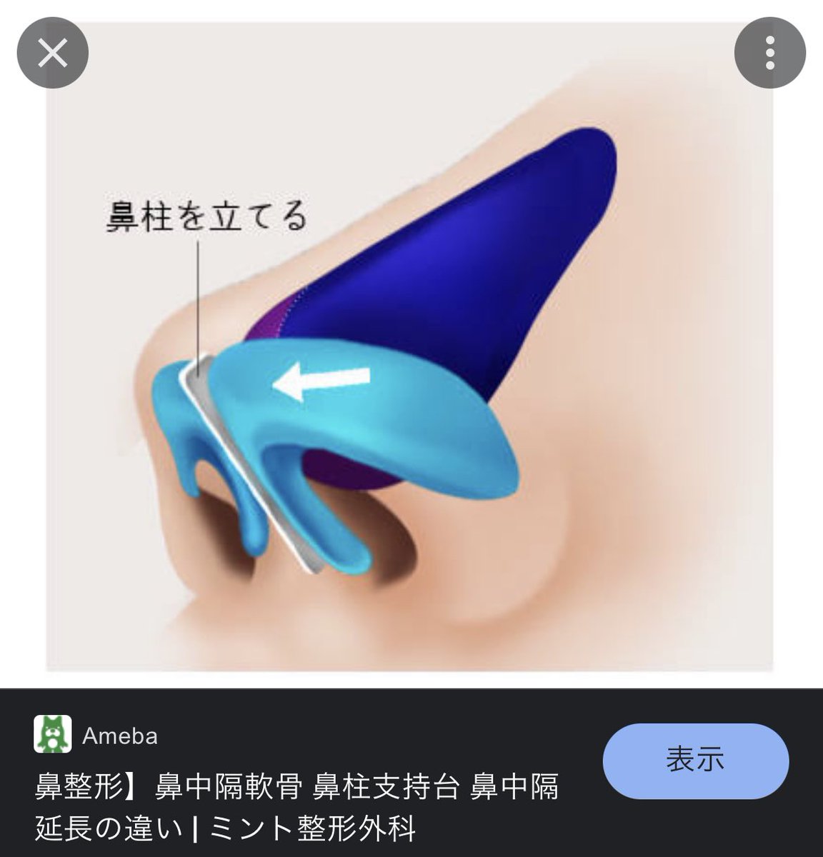 pu_chica's tweet photo. #鼻中隔延長 
#鼻柱下降
#鼻唇角形成
#鼻尖形成 

韓国では、これらの手術で鼻に軟骨（肋軟骨か鼻中隔軟骨か）を画像のように挿入し、「鼻柱支持台」を作ります。

日本ではこういう言葉がないです。。 https://t.co/5qoS4Ikib8