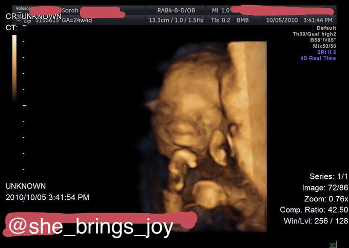 shebringsjoy's tweet photo. This is what a #FatalFetalAnomaly looks like at 24 weeks. 

Remember that the next time a legislator suggests adding an exception for lethal birth defects into #ProLife legislation. 

#LifeLimitingCondition #IncompatibleWithLife #CompatibleWithLove
#CTT #CarryToTerm #TFMR https://t.co/0wHOzx9Da8