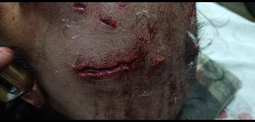 Indian__doctor's tweet photo. #BRUTAL_ATTACK
Dr MUKESH 
jhadol, Falasiya Hospital,#Rajasthan Attacked by moreThan 2dozens Goons.
Situation Critical

This is what doctors are getting after sacrificing in #coronavirus pandemic!

StronglyDemand #centralProtectionAct &amp;strict punishment @ashokgehlot51
#MedTwitter https://t.co/qNJuIL0bcC