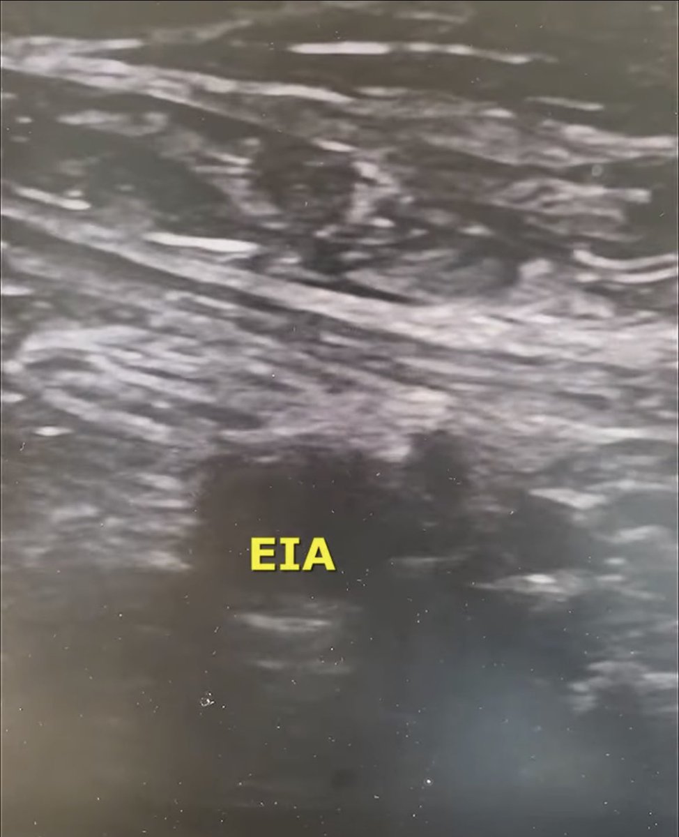 HadyLichaaMD's tweet photo. #VascularAccessUStip
If Fluoro not available (ED, CCU, some OR) identify #InguinalLigament to avoid a #HighStick
https://t.co/XdLwCCA9XM
@NickMouawadMD @MichaelMegalyMD @mirvatalasnag @agtruesdell @mmamas1973 @DLBHATTMD @_backtable @Vascupedia_com @SCAI #ACCearlyCareer #ACCFIT https://t.co/fRRlJ31gLS