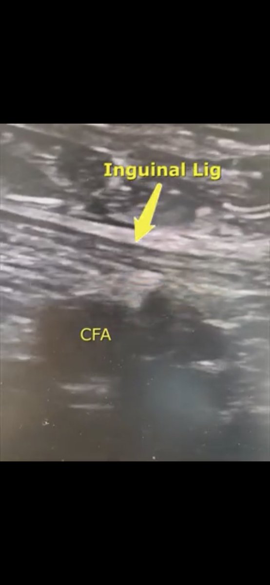 HadyLichaaMD's tweet photo. #VascularAccessUStip
If Fluoro not available (ED, CCU, some OR) identify #InguinalLigament to avoid a #HighStick
https://t.co/XdLwCCA9XM
@NickMouawadMD @MichaelMegalyMD @mirvatalasnag @agtruesdell @mmamas1973 @DLBHATTMD @_backtable @Vascupedia_com @SCAI #ACCearlyCareer #ACCFIT https://t.co/fRRlJ31gLS