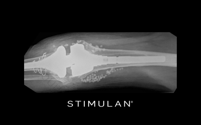 Biotechsa's tweet photo. STIMULAN® - In this trial, we evaluated the incidence of periprosthetic joint infections (PJI), after local or intravenous (IV) antibiotic prophylaxis - https://t.co/fX78gIiT73 #biotechsa #stimulan #infections https://t.co/cLWkJBmvSG
