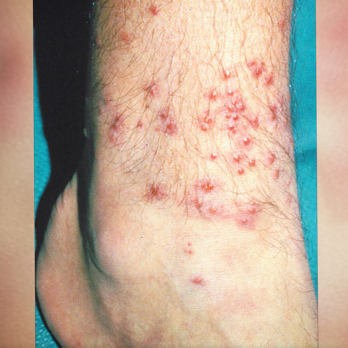 Coyote Peterson (@coyotepeterson) on Twitter photo These baddies are microscopic parasites that chew up unlucky Coyote Petersons that go wandering barefoot through the forest… Yes I get bit… Won’t tell you where... Massive thanks to <a href="/StingKill/">Sting-Kill</a> Chiggerex for sponsoring my latest adventure!
Live now: youtu.be/E2ZW1MlRkfU These baddies are microscopic parasites that chew up unlucky Coyote Petersons that go wandering barefoot through the forest… Yes I get bit… Won’t tell you where... Massive thanks to <a href="/StingKill/">Sting-Kill</a> Chiggerex for sponsoring my latest adventure!
Live now: youtu.be/E2ZW1MlRkfU