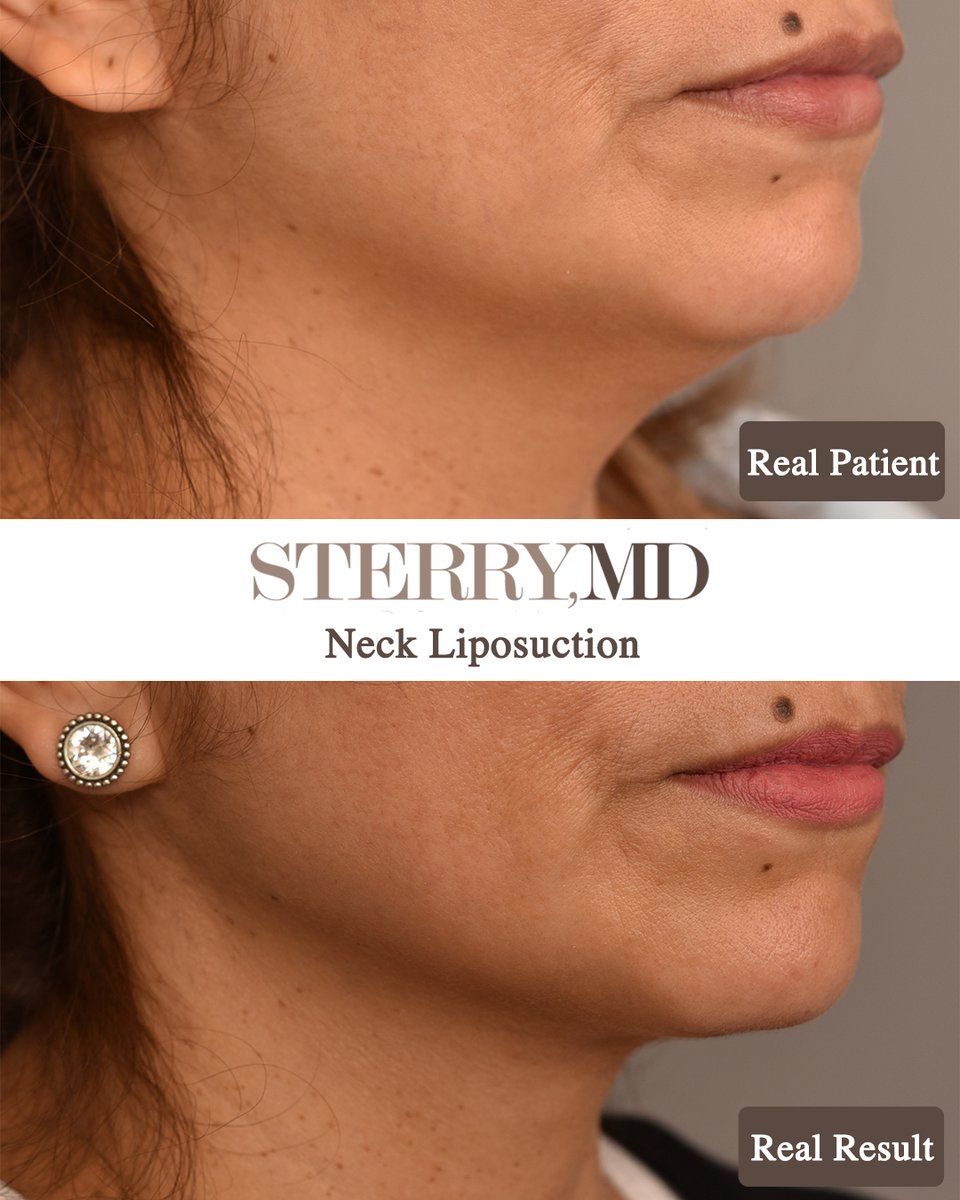 Say Goodbye to your #doublechin! 

My patient jawline is so much more defined and she is really happy with her outcome!

#chinliposuction #chinliponyc #submentalfat #doublechinremoval