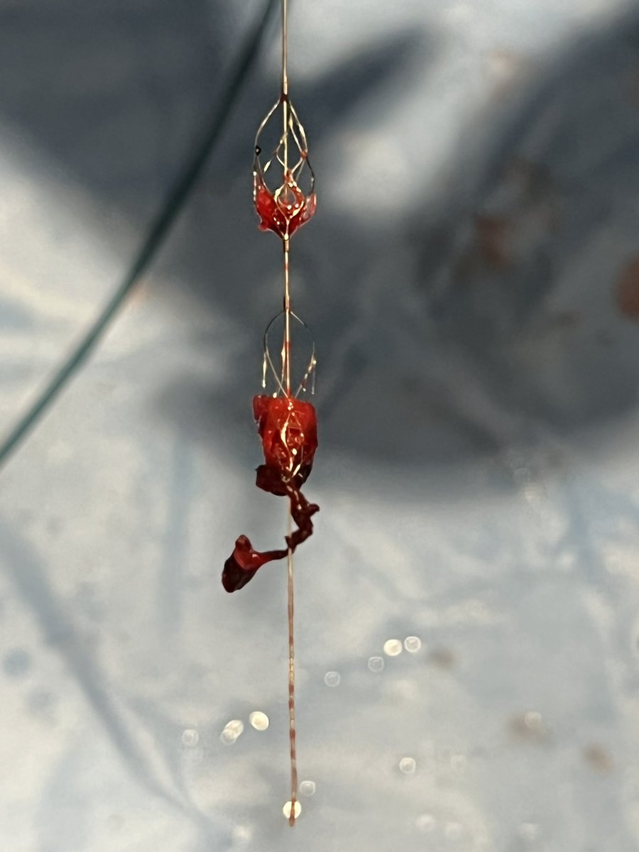 mcarlson091's tweet photo. Pounce for the win- no ICU, no lytics, acute and chronic clot removal #clotha #savetheleg #ontableresults #easeofuse https://t.co/Mw066eF2TO