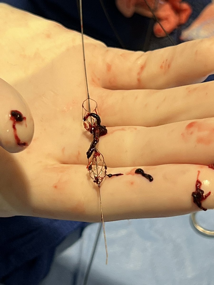 mcarlson091's tweet photo. Pounce for the win- no ICU, no lytics, acute and chronic clot removal #clotha #savetheleg #ontableresults #easeofuse https://t.co/Mw066eF2TO
