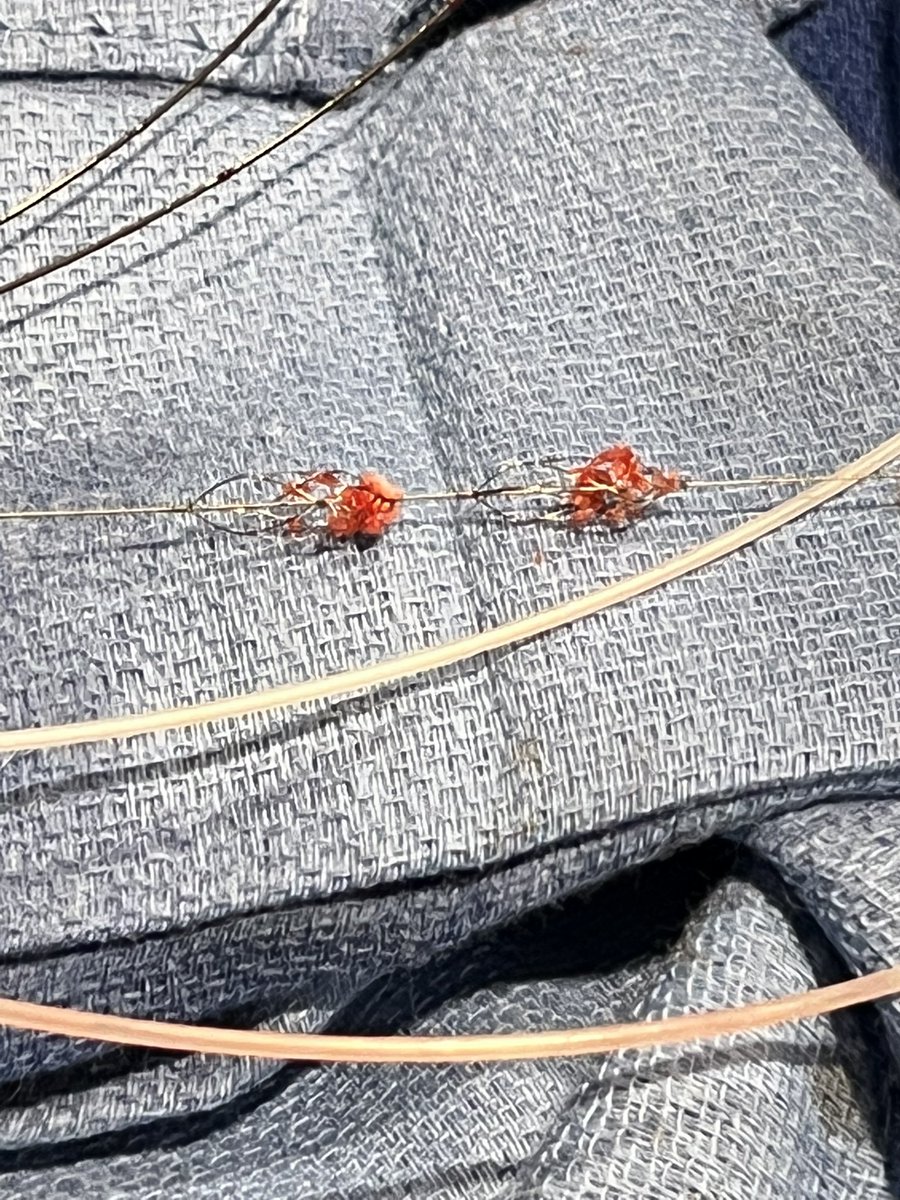 mcarlson091's tweet photo. Pounce for the win- no ICU, no lytics, acute and chronic clot removal #clotha #savetheleg #ontableresults #easeofuse https://t.co/Mw066eF2TO
