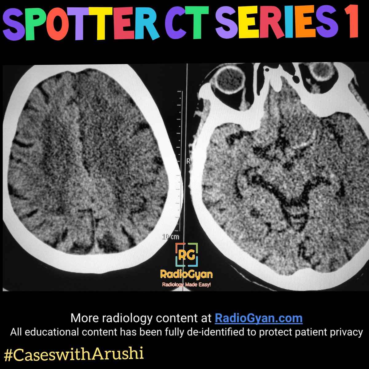 TeamRadioGyan's tweet photo. #SaturdaySpotter

Welcoming you with another fun spotter for this week.
⠀
Hosted by #teamgyan member Dr. Arushi Gupta. Follow her on @radiologywithdrarushi for more.
⠀
#ct #ctbrain #brainradiology #emergency #FOAMrad #radres #radiology #radiogyan #studygram #study #learning https://t.co/y3hUJSKRSu