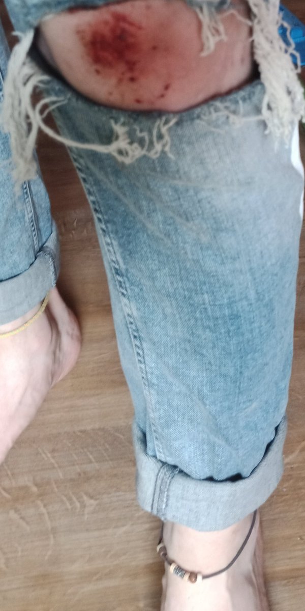 CN Verletzung
. 
Es es gar nicht so verkehrt wenn 1 auch mal mit der Mode geht.
Eine spießige Standard-Jeans wäre nun kaputt. 😎