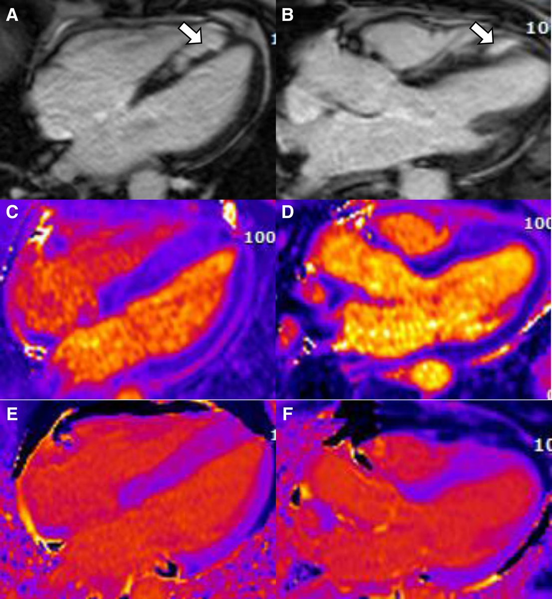 MasriAhmadMD's tweet photo. A new @CircImaging #CircImage of an atypical presentation of cardiac #Sarcoidosis 

#WhyCMR is show which was followed by #CVNuc #PET and biopsy 

Read more: https://t.co/8KB0MUcgLh 

#CardioTwitter https://t.co/CIPNfIJQ4I