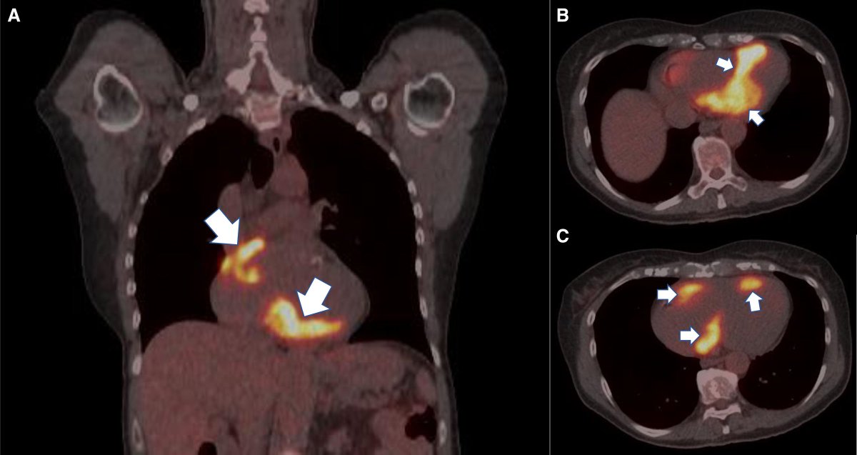 MasriAhmadMD's tweet photo. A new @CircImaging #CircImage of an atypical presentation of cardiac #Sarcoidosis 

#WhyCMR is show which was followed by #CVNuc #PET and biopsy 

Read more: https://t.co/8KB0MUcgLh 

#CardioTwitter https://t.co/CIPNfIJQ4I