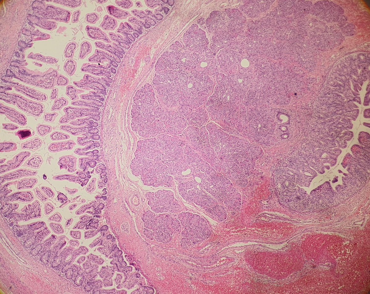 ozkanaydin1986's tweet photo. Meckel diverticulum @ozkanaydin1986 #gispathology #gispath #pathology https://t.co/T1a7bLvIwr