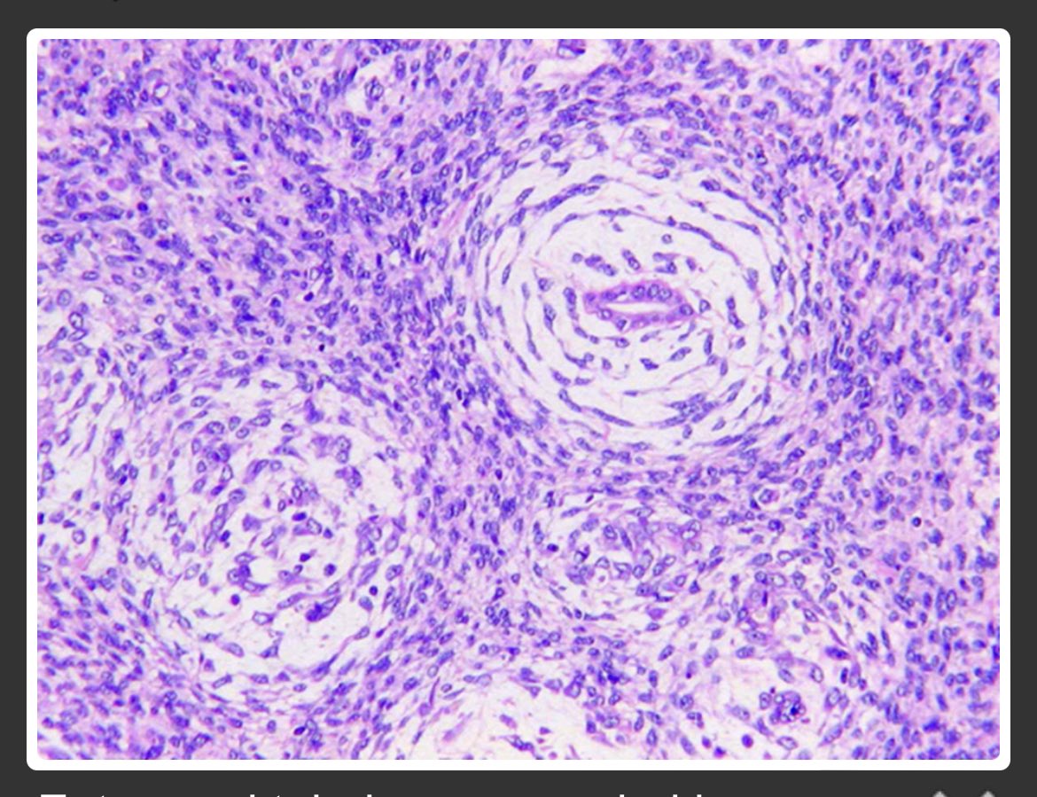 Who am I series: 

I am Rare benign kidney tumor with multinodularity and  usually I show Onion skin" cuffing around entrapped tubules.. I am is associated with BRAF V600E mutations .. 

Who am I ? 

 #pathology #pathologist #ssmc #thepowerofcare #PathTwitter