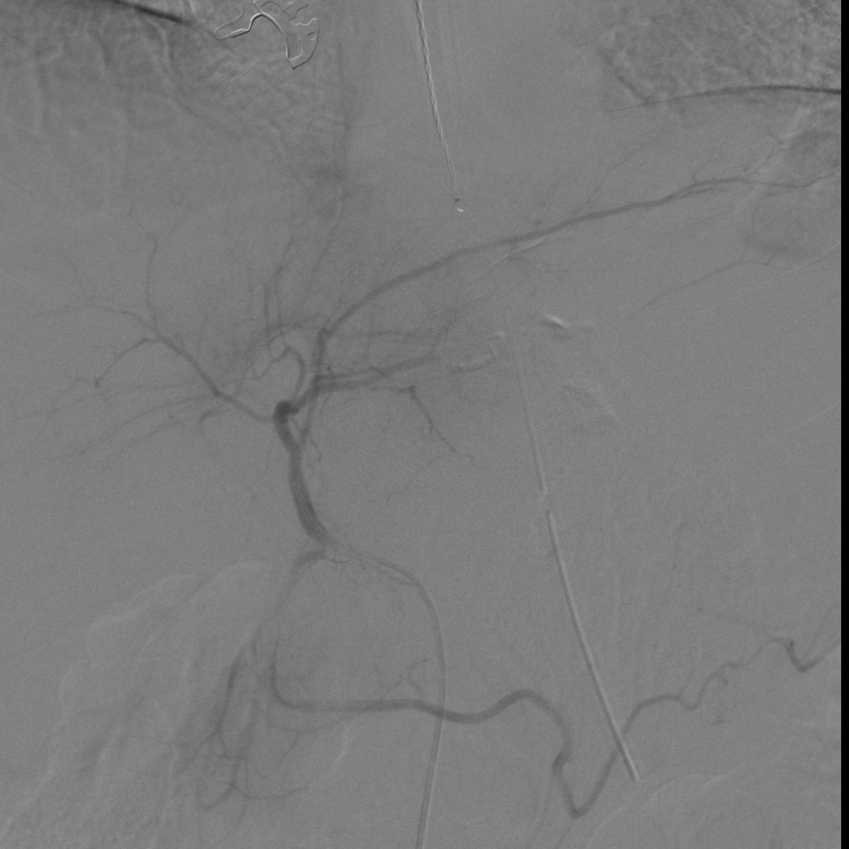 Trauma patient on massive transfusion protocol due to hemorrhage from hepatic segment III. Immediate hemostasis achieved with 0.1 cc of 1:2 glue. Patient stabilized and discharged in a few days. #iRad #MedTwitter #justglueit #Trauma #stopthebleed #iradres #WithoutAScalpel