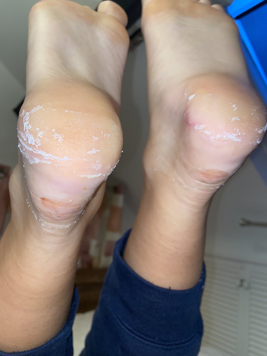 The feet of 35 peaks and 50 miles - three days down, two to go….please support these warriors of girls in raising much needed funds for MNDA if you possibly can #ketasjourney #mndassociation