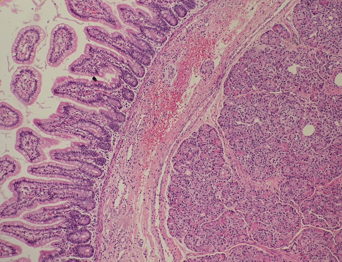 ozkanaydin1986's tweet photo. Meckel diverticulum @ozkanaydin1986 #gispathology #gispath #pathology https://t.co/T1a7bLvIwr