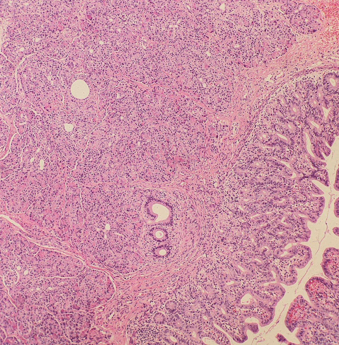 ozkanaydin1986's tweet photo. Meckel diverticulum @ozkanaydin1986 #gispathology #gispath #pathology https://t.co/T1a7bLvIwr