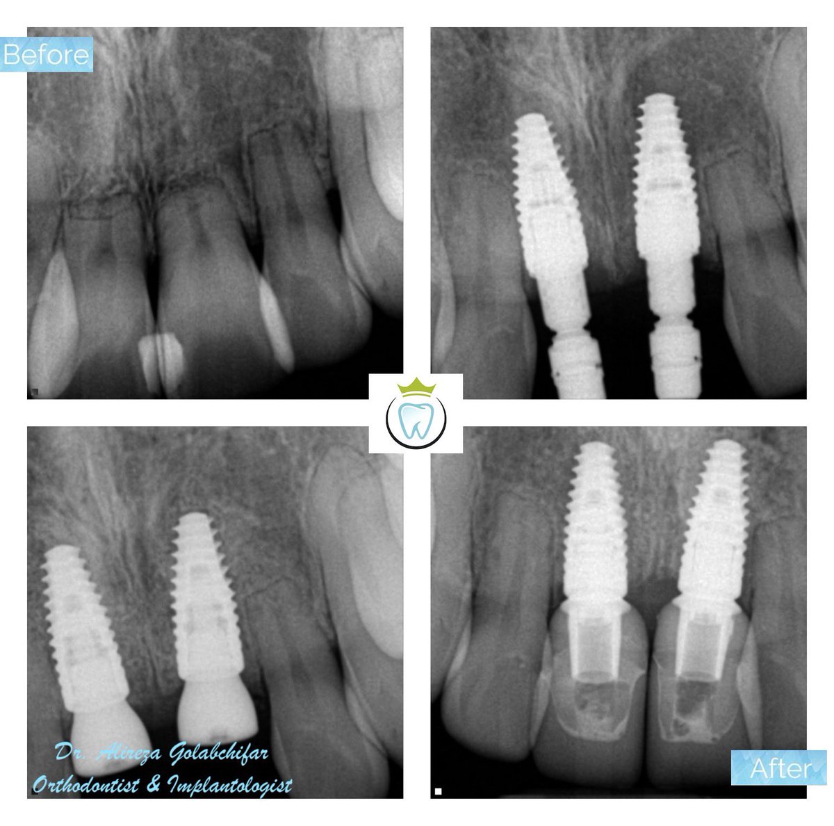 dentistry_king's tweet photo. Check out this Transformation!
This young patient came to us with Multiple idiopathic external apical root resorption (MIEARR) &amp; upper anterior crowding.  We were able to align her upper anterior teeth with extraction of tooth #11 and #21 followed by immediate implant placement. https://t.co/hYHUtdAfiP