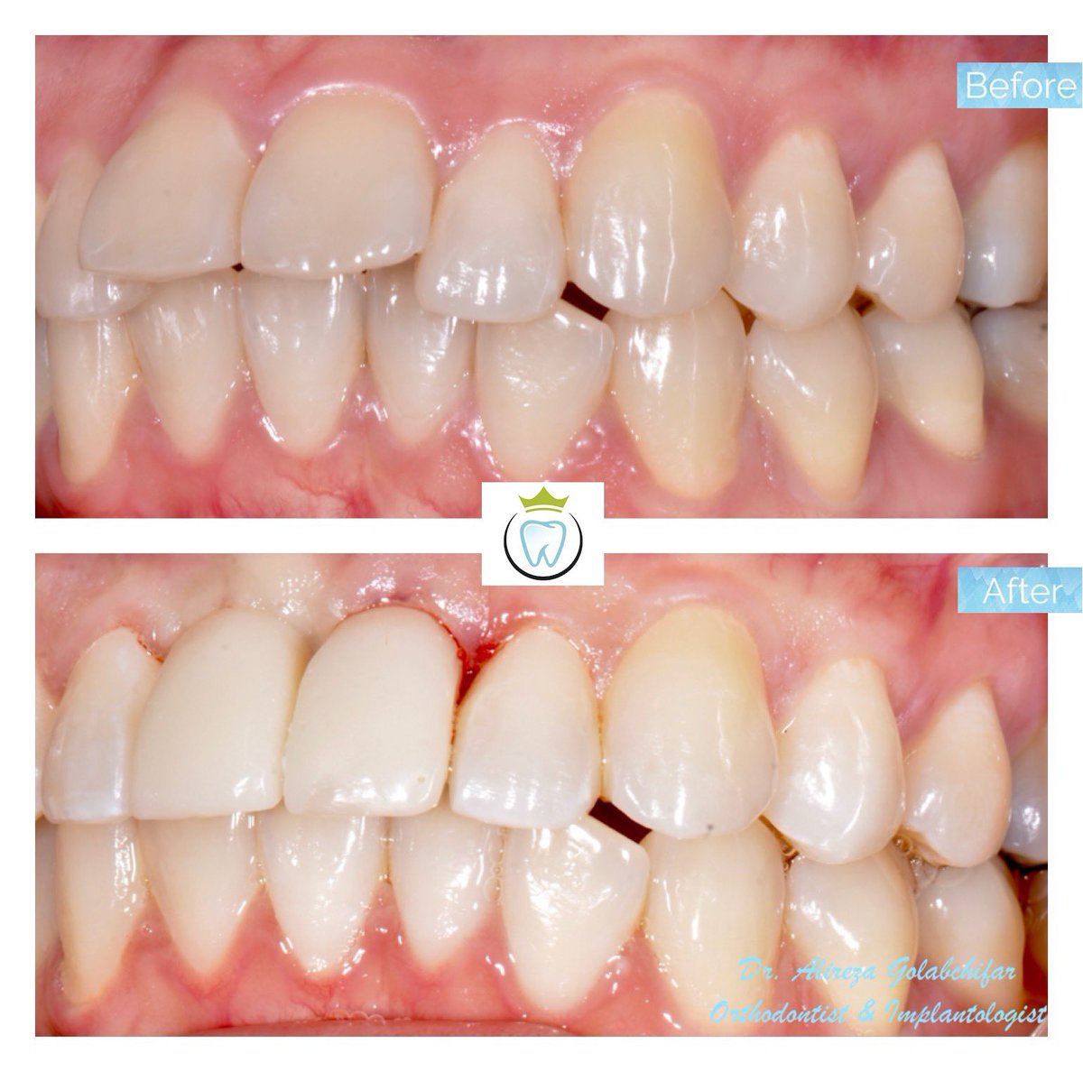 dentistry_king's tweet photo. Check out this Transformation!
This young patient came to us with Multiple idiopathic external apical root resorption (MIEARR) &amp; upper anterior crowding.  We were able to align her upper anterior teeth with extraction of tooth #11 and #21 followed by immediate implant placement. https://t.co/hYHUtdAfiP