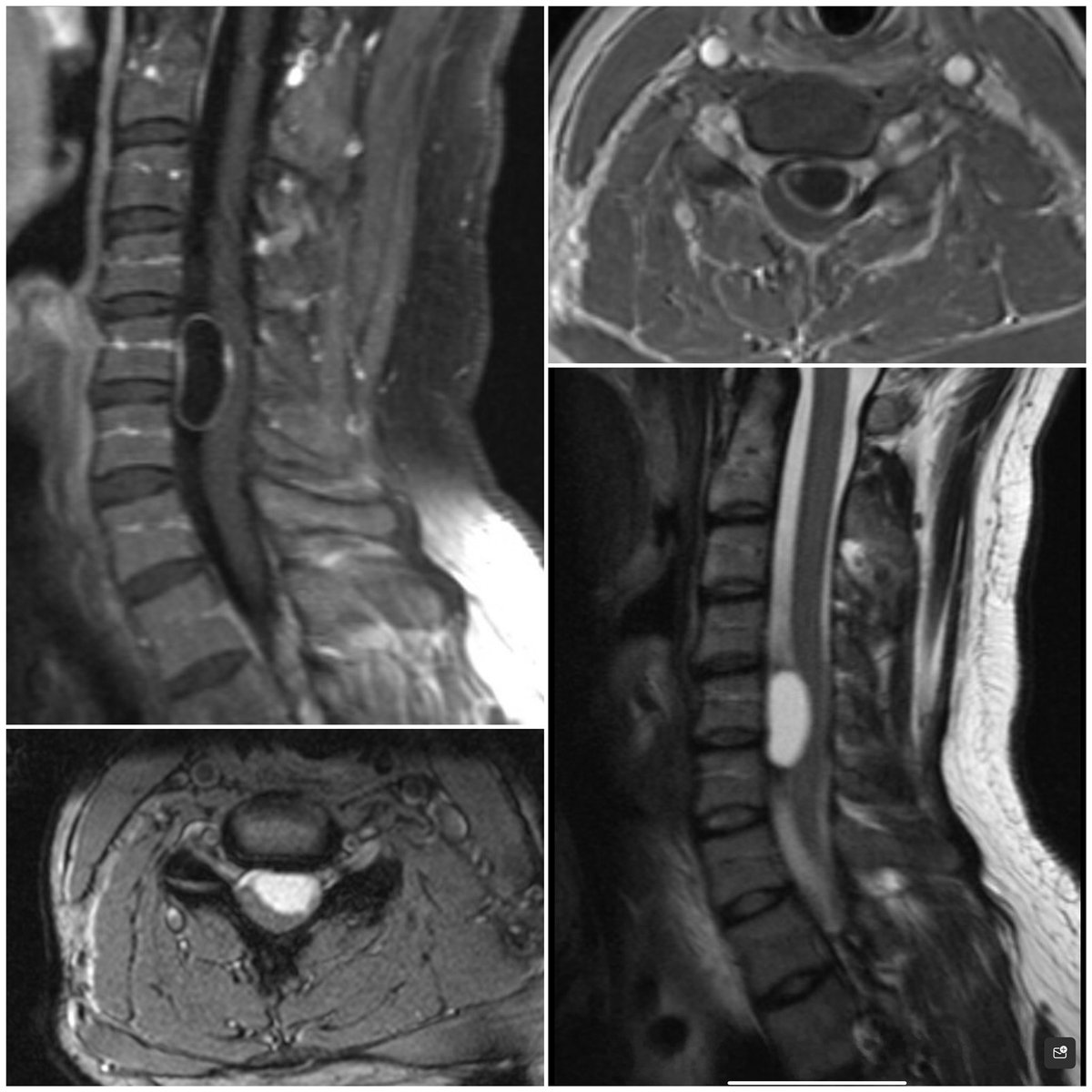 AJGrossbach's tweet photo. 32 yo M presents with progressive neck pain, L arm pain, and L arm numbness. History of hemophilia A and Ehlers-Danlos Syndrome. What’s your diagnosis and treatment plan? https://t.co/2LsSmVe0x9