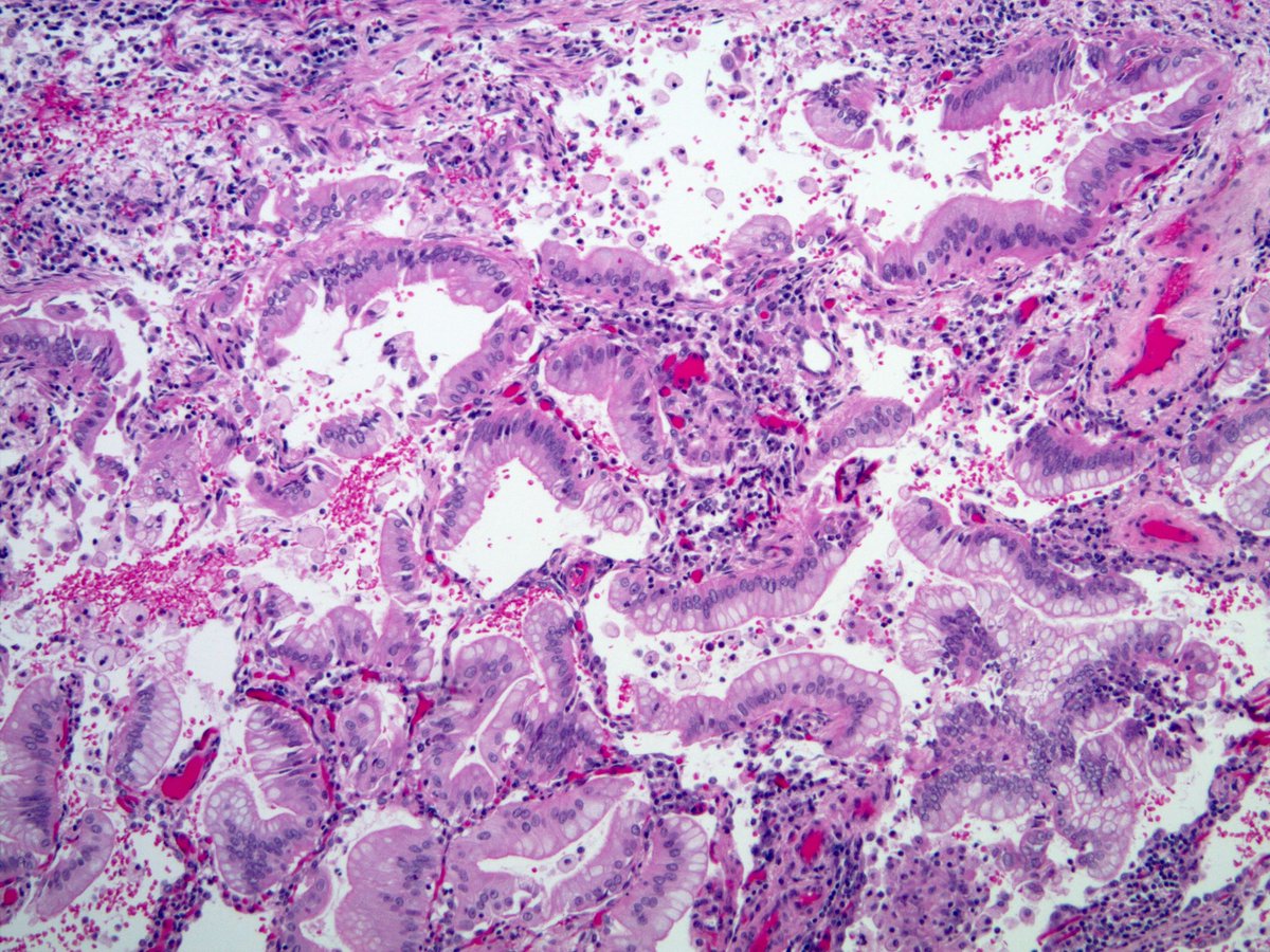 This is an unfair case just on a few images but it is indeed mucinous adenocarcinoma (resection pics 👇🏾). So difficult on cytology because the nuclei are not overtly malignant. However, there are other subtle clues (eg no cilia) and comparison with benign bronchial cells helps