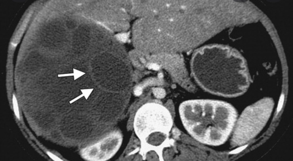 What #parasite caused this appearance of the #liver? #radiology #via Radiographics #radres #radtwitter #meded