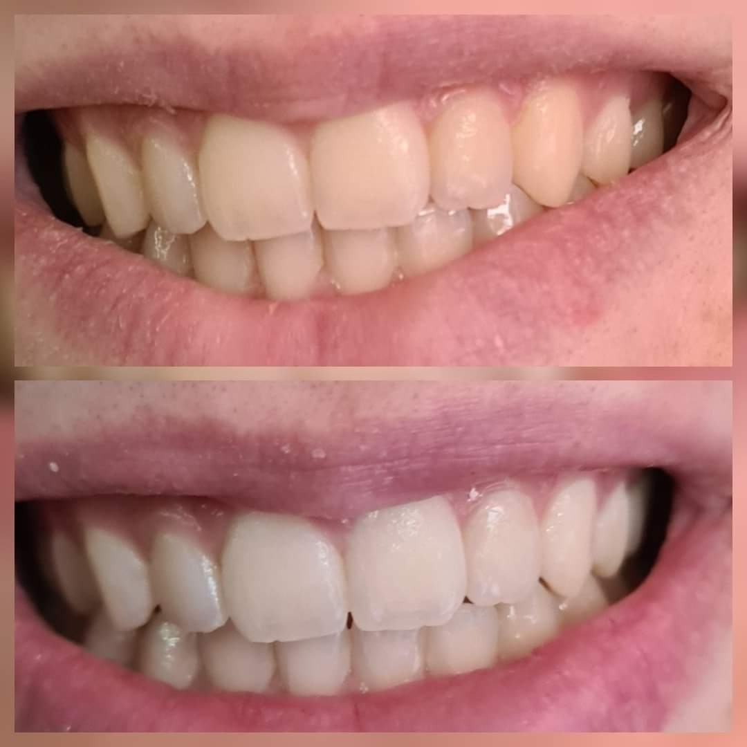 Blanchiment du jour 
gagnez 4 à 8 teintes en une séances 50mn à 50€ au lieu de 80€ 

Achetez ici bodyfish.fr/carte-cadeau-p…