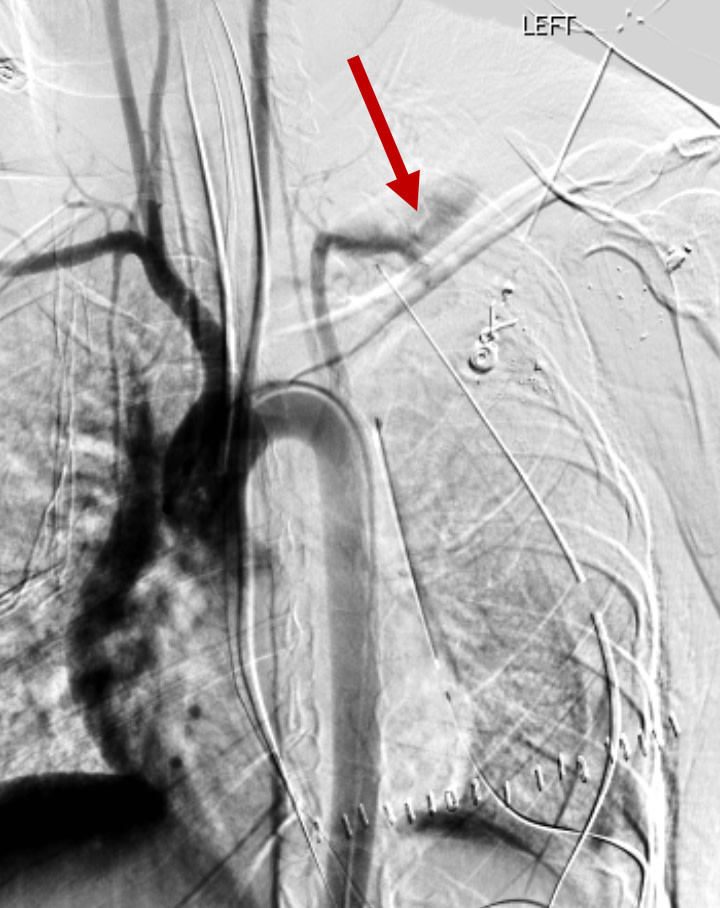 Applied_Rad's tweet photo. Interventional Case Study | Stent Grafting for Traumatic Arterial Injuries Full case ⏩https://t.co/mt4XNNi64U #MedStudent #FutureRadRes #FutureIR #IRad #VIR #IR #RadRes @DivyaKumariMD @UChicagoIR @SIRRFS https://t.co/SjPmrGNhl3